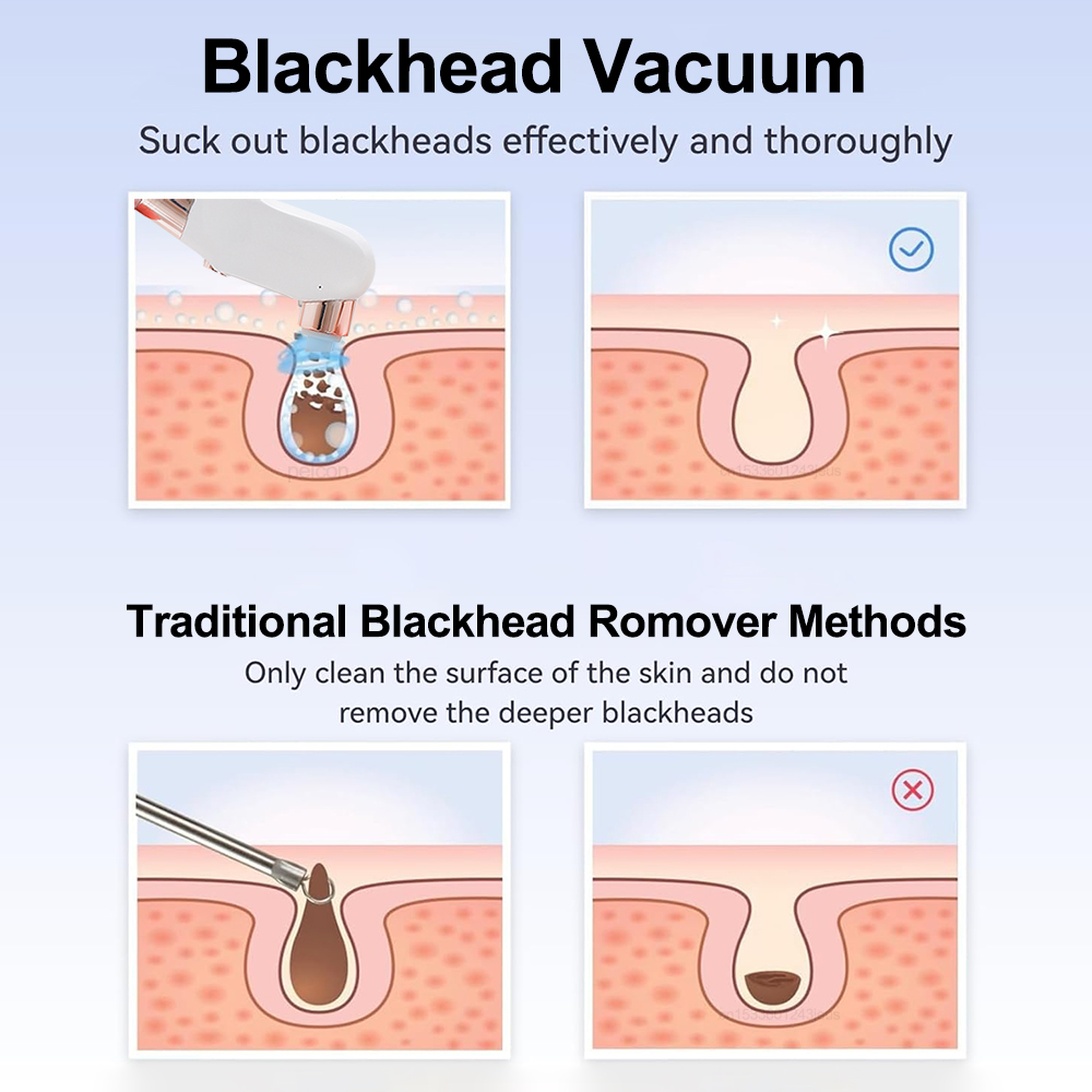Electric Blackhead Remover Vac - огляд і ціна Pore Vacuum