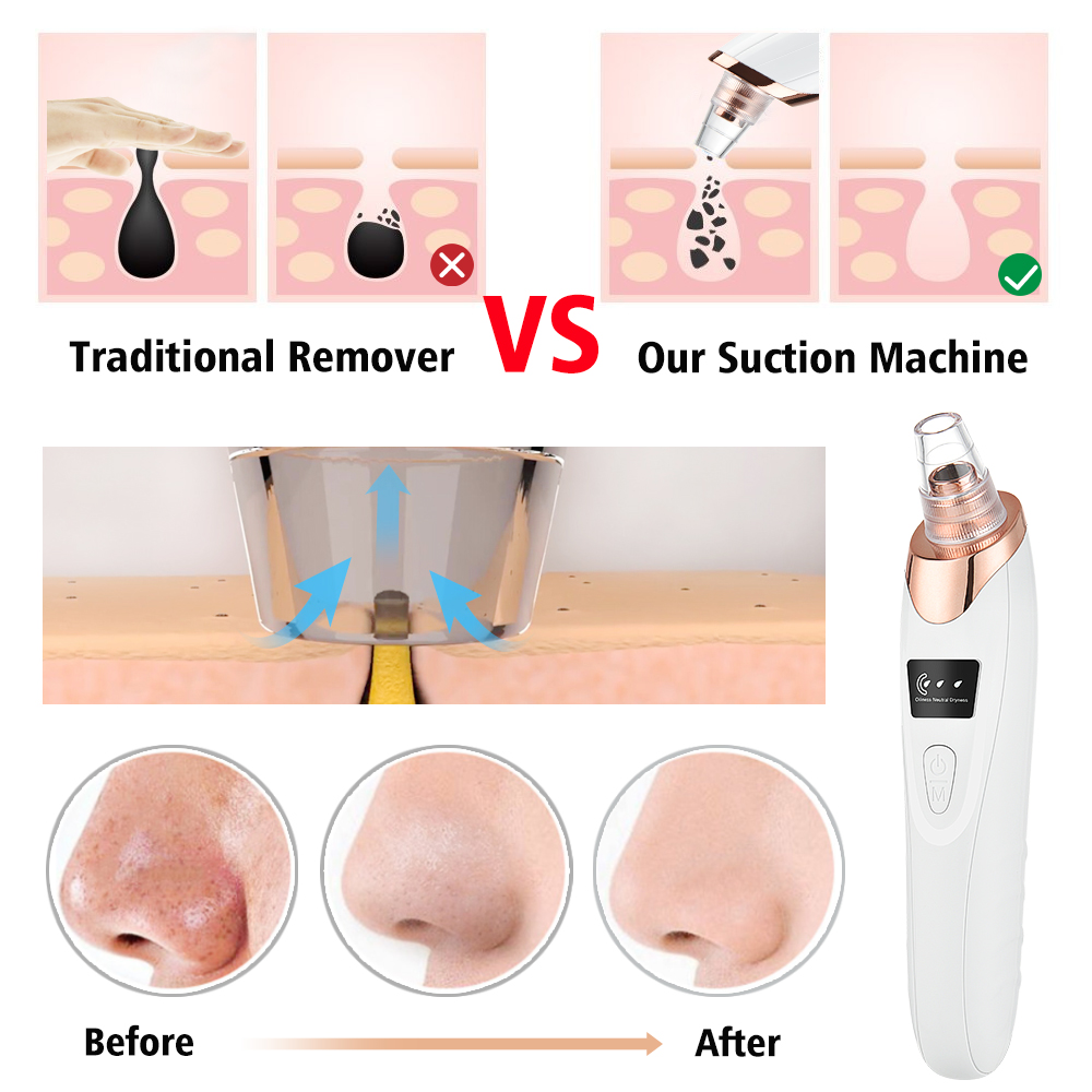 Blackhead Remover Vacuum Pore  - огляд і ціна Pore Vacuum